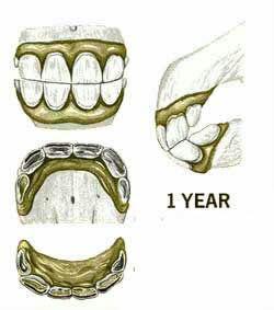 دندان اسب در یک سالگی